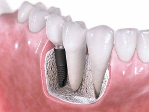 Dental Implants Preston