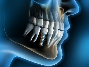 Dental-Implants