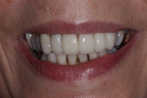 Smile Makeovers Preston