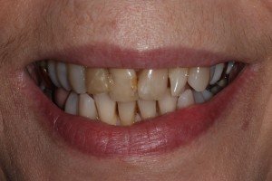 Smile Makeovers Preston