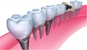 Dental Implants in Preston