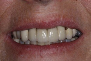 Dental Implants Preston