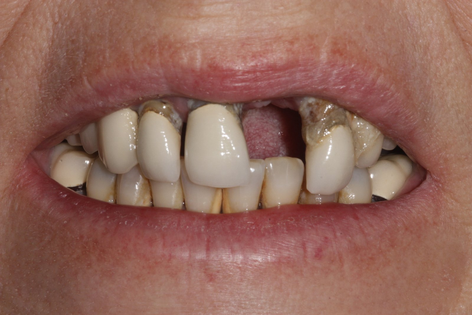 Dental Implants Preston
