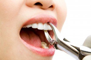 Extractions Preston