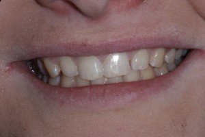 Dental Bonding Preston
