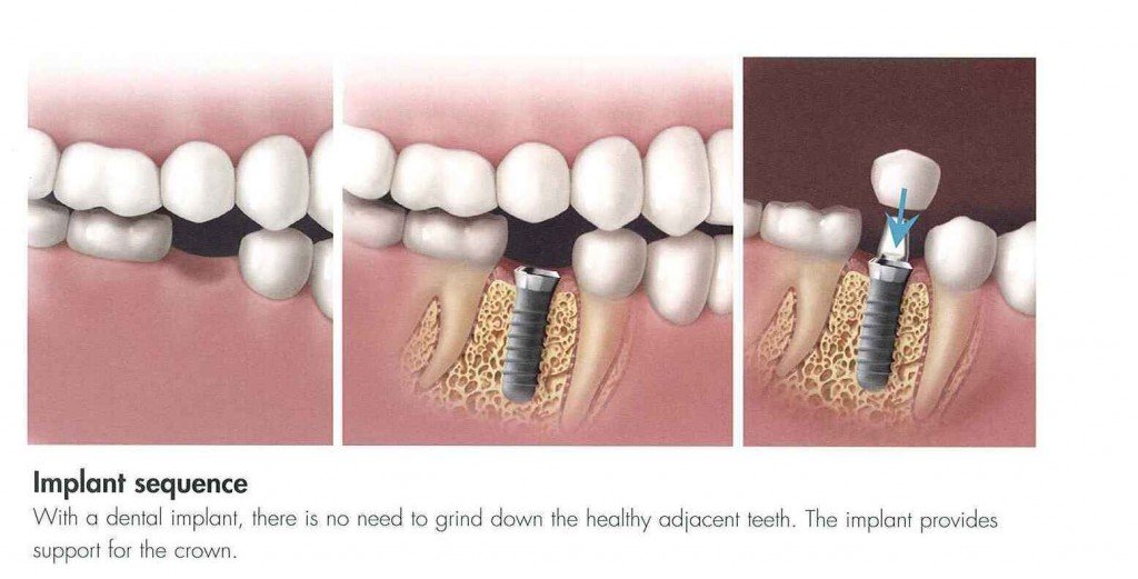 Dental Implants Procedure